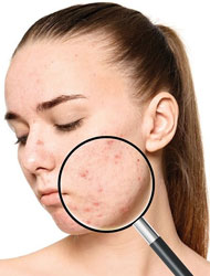 acne(pimple) treatment