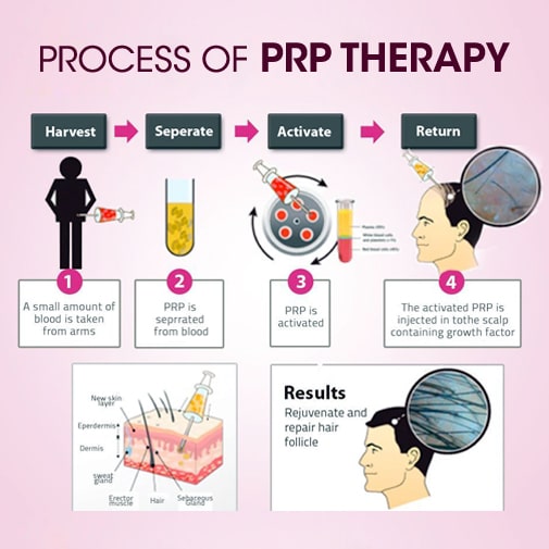 process of PRP therapy