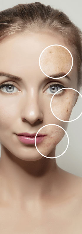 acne scar treatment